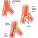 Computed tomography a suitable diagnostic alternative for obstructive coronary artery disease