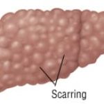 Non-alcoholic fatty liver disease-related hepatocellular carcinoma (HCC) differ clinically compared to HCC due to other causes