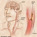 Endovascular therapy for large ischemic strokes provides better functional outcomes