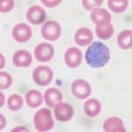 Higher-dose primaquine has higher efficacy in preventing relapse of Plasmodium vivax malaria