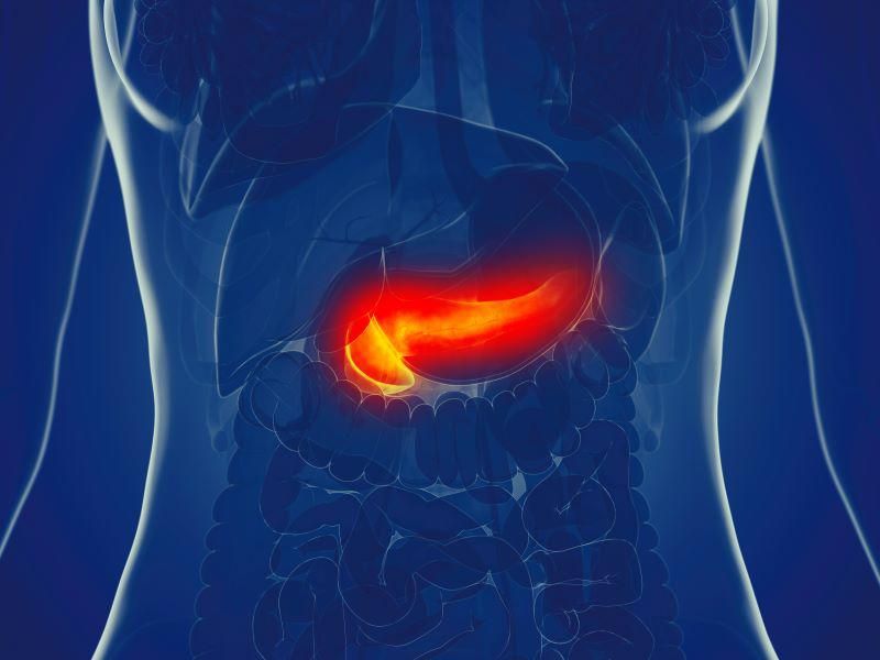 AI Tool May Help Predict Risk for Pancreatic Ductal Adenocarcinoma