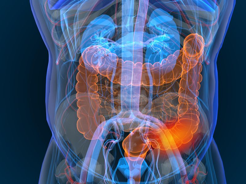 DDW: Antibiotics Up Risk of Older-Onset Inflammatory Bowel Disease