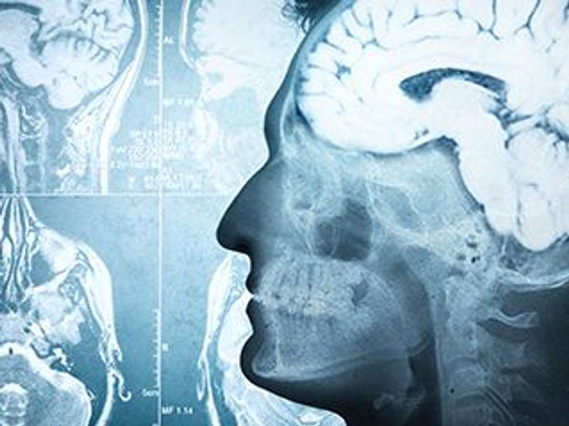 Choroid Plexus Volume Up With Advanced Cognitive Impairment