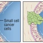 Adebrelimab plus chemotherapy improves overall survival in extensive-stage small-cell lung cancer