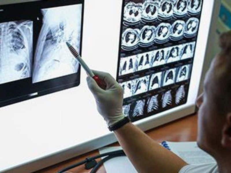 AI Aids Assessment of Indeterminate Pulmonary Nodules on CT