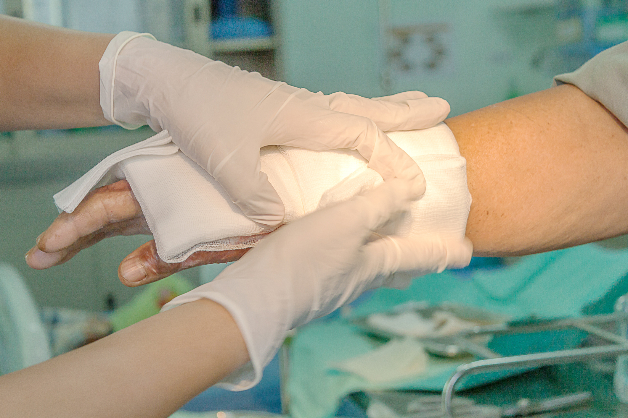 Hydrogel Burn Dressing Superior to Silver Sulfadiazine for Severe Burns