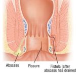 Treatment of anal high-grade squamous intraepithelial lesions can reduce rates of progression to invasive anal cancer.