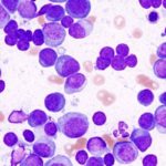 LCAR-B38M CAR-T cell therapy promising at 4-year follow-up for treatment of refractory multiple myeloma