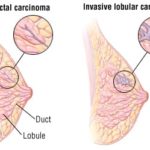 Pembrolizumab plus chemotherapy improved survival in a subgroup of triple-negative metastatic breast cancer