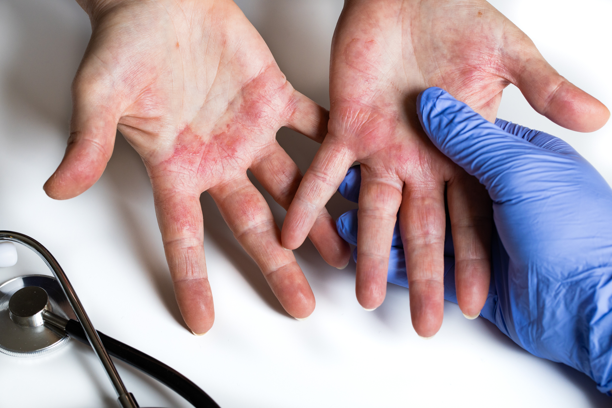 Climatic Hazards Linked to Aggravation of Atopic Dermatitis