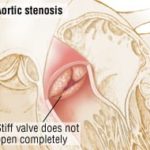 Early left ventricular ejection fraction improvement post transcatheter aortic valve replacement associated with improved 5-year clinical outcomes