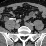 Nonoperative management of uncomplicated acute appendicitis comparable to appendectomy but leads to increased length of stay and disease recurrence