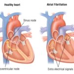 Left atrial appendage occlusion is an effective alternative to oral anticoagulation in atrial fibrillation