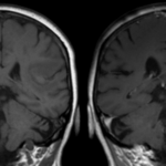 Remote ischemic conditioning associated with better neurologic function in patients with acute moderate ischemic stroke – the RICAMIS trial