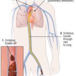 Aspirin associated with significantly higher rate of symptomatic venous thromboembolism compared to enoxaparin in patients undergoing hip or knee arthroplasty – the CRISTAL randomized trial