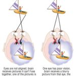 Race and insurance status may affect amblyopia treatment outcomes