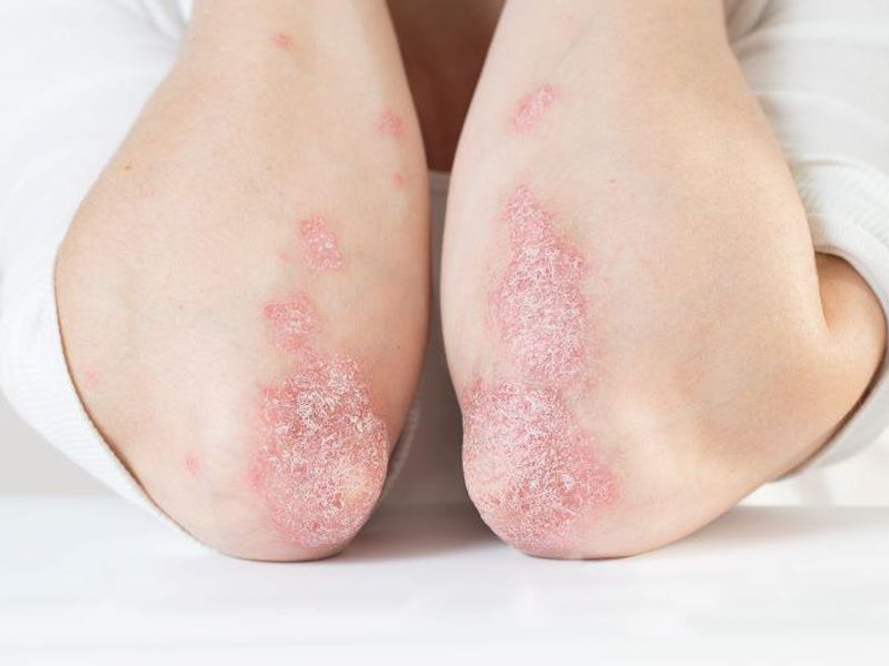 Psoriasis Patients Find Psoriatic Arthritis Screening Worthwhile