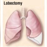 Adjuvant pembrolizumab increased disease-free survival in completely resected, PD-L1 unselected non-small-cell lung cancer patients