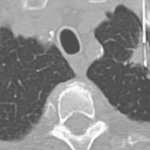 Exposure to particulate matter 2.5 μm or less associated with adverse outcomes among patients with fibrotic interstitial lung disease