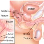 Variation in prostate cancer screening rates associated with subsequent metastatic prostate cancer incidence