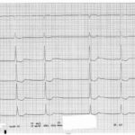 Contemporary pattern of treatment time and in-hospital mortality among US patients with ST-segment elevation myocardial infarction between 2018-2021