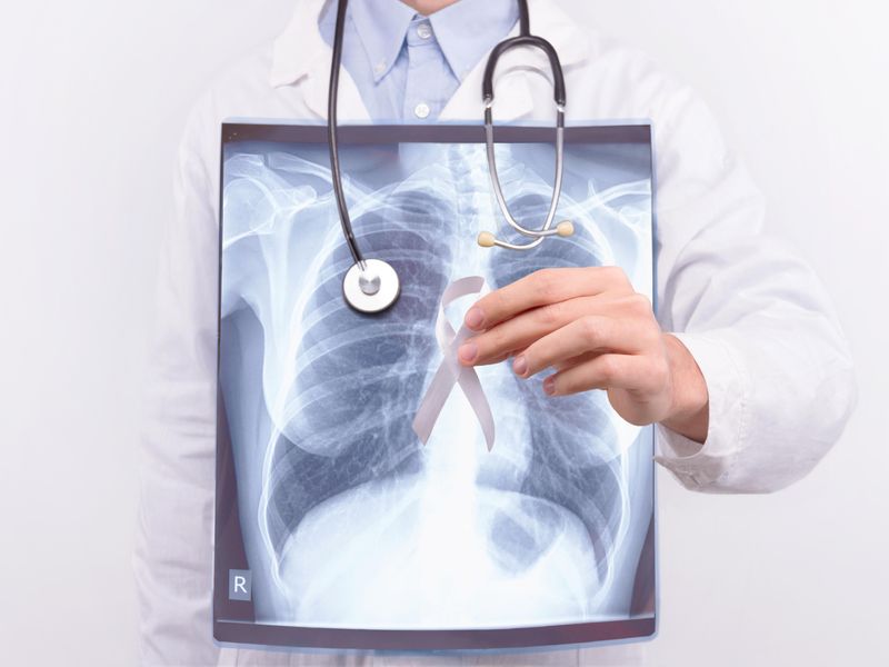 Decrease Noted in Lung Cancer Cases Over Past Five Years