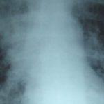 Shorter antibiotic course non-inferior to longer course for pediatric community-acquired pneumonia