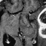 Adding autologous tumor lysate-loaded dendritic cell vaccination to standard of care associated with clinical improvement in overall survival for patients with newly diagnosed and recurrent glioblastoma