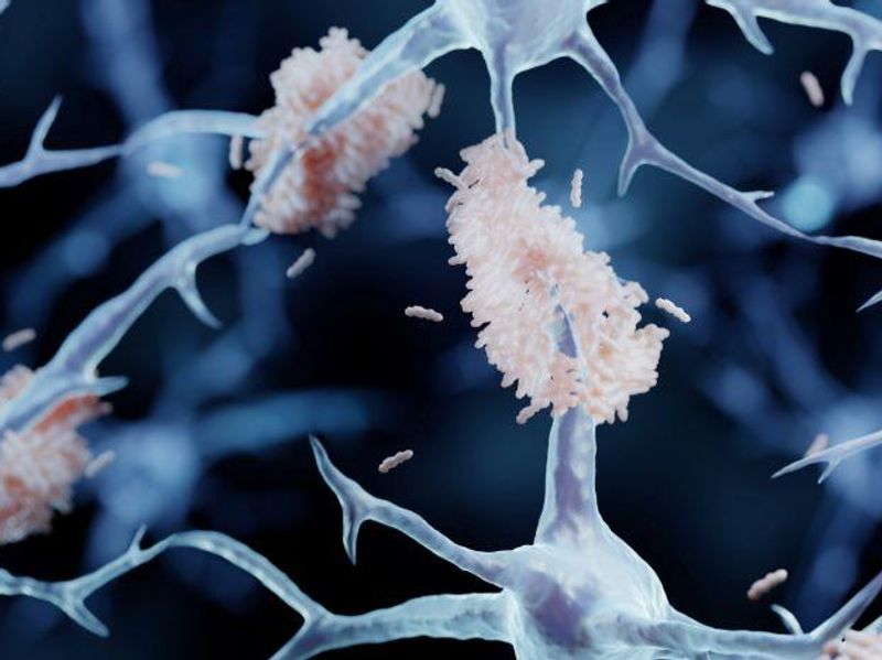 Lecanemab Reduced Markers of Amyloid in Early Alzheimer Disease