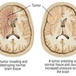 Autologous tumour lysate-loaded dendritic cell vaccine in conjunction with standard treatment for glioblastoma may increase overall survival