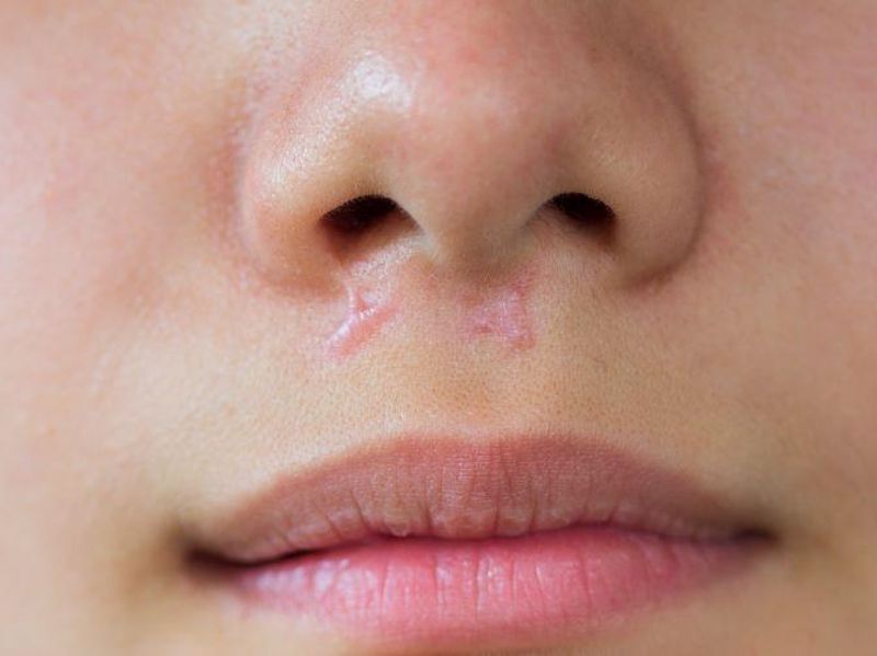 Facial Scars Do Not Affect Perceived Attractiveness, Confidence