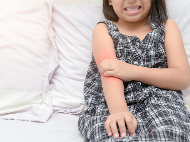 Atopic Dermatitis Raises Subsequent Fracture Risk in Children