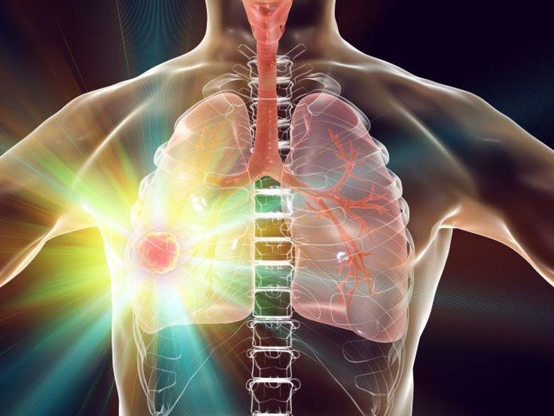 Robotic Bronchoscopy Plus Advanced Imaging Accurate for Diagnosing Lung Malignancy