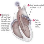 Adding posterior wall isolation to pulmonary vein isolation not beneficial in ablation for patients with persistent atrial fibrillation — the CAPLA trial