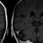 Left atrial reservoir strain improves ischemic stroke risk prediction in low-risk patients