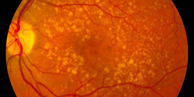 Age-related macular degeneration may be associated with depression risk