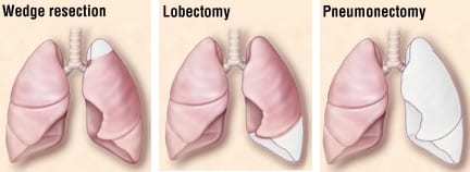 Lobar vs Sublobar Resection for Peripheral Stage IA NSCLC