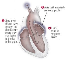 Left atrial strain and left atrial strain rate independently associated with risk of ischemic stroke in older adults