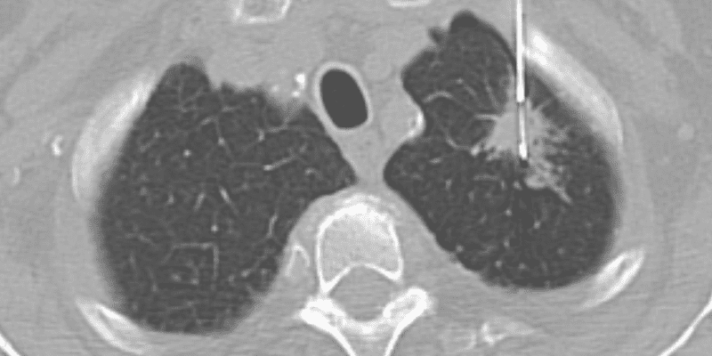 Risk model-based lung cancer screening is more cost effective than current practice