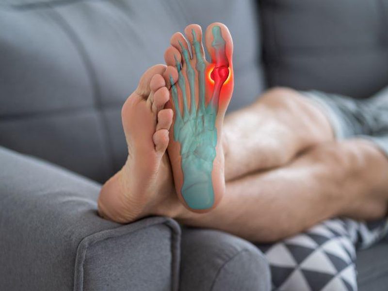 History of Gout Tied to Risk for BPPV, Meniere Disease