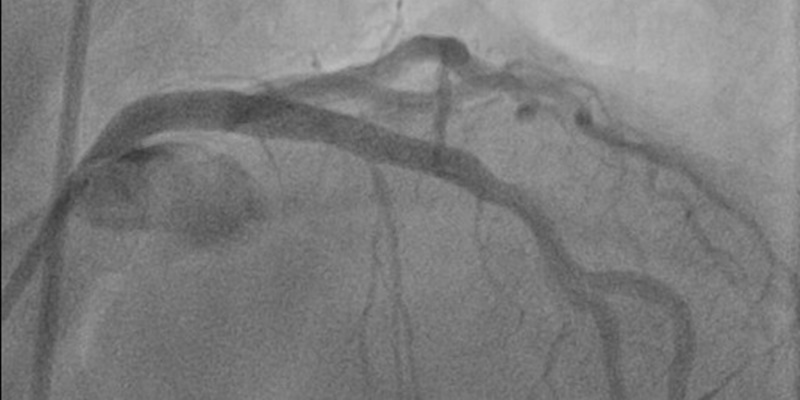 Routine invasive strategy not associated with improved outcomes in older adults with frailty and non-ST segment elevation acute myocardial infarction