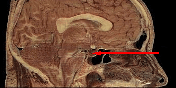 Pituitary microadenomas exhibit slow growth and may require less frequent MRI surveillance