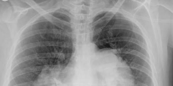 Sotorasib superior to docetaxel for treatment of KRASG12C-positive non-small-cell lung cancer