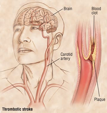 Transcarotid artery revascularization not associated with a significant difference in 30-day risk of stroke, death and myocardial infarction compared to carotid endarterectomy