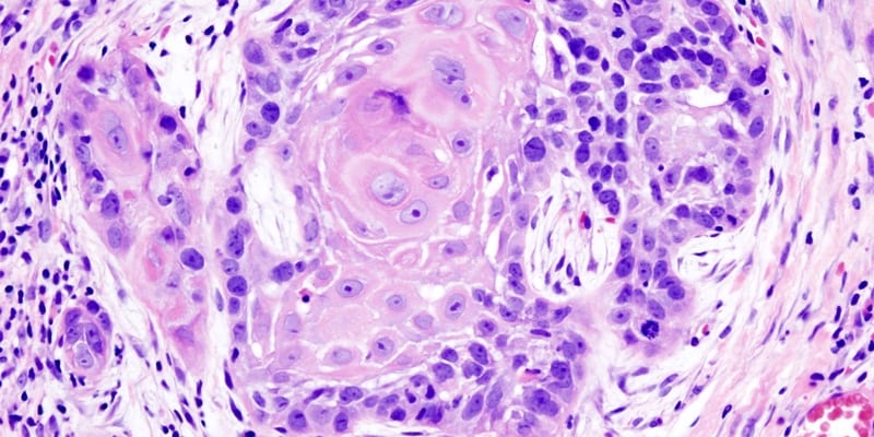 Hyperfractionated radiotherapy reduces complication rates compared to standard fractionation for locally advanced nasopharyngeal carcinoma