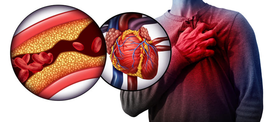 Hemodynamic Monitoring Improves Quality of Life and Lowers Hospitalizations in Patients With HF