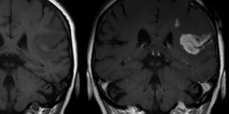 Relationship between mean blood pressure and clinical outcome after acute ischemic stroke