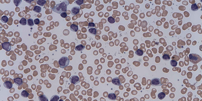 Venetoclax in addition to ibrutinib effective as a treatment for chronic lymphocytic leukemia