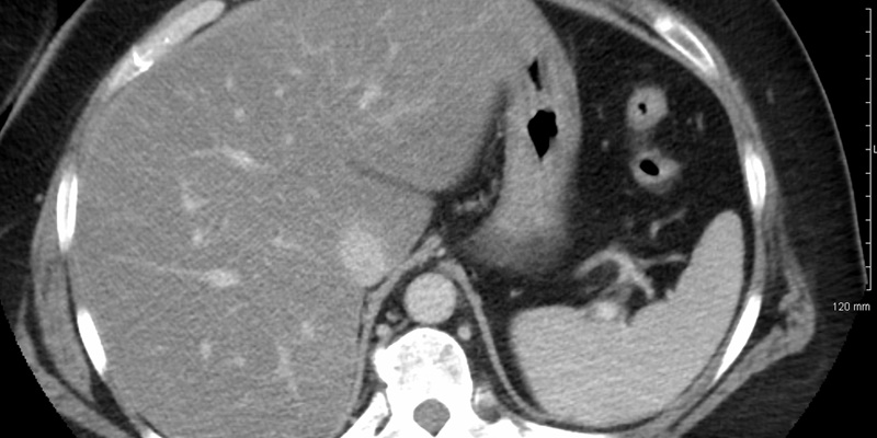 Tumour stroma ratio predicts prognosis and PD-L1 expression in hepatocellular carcinoma