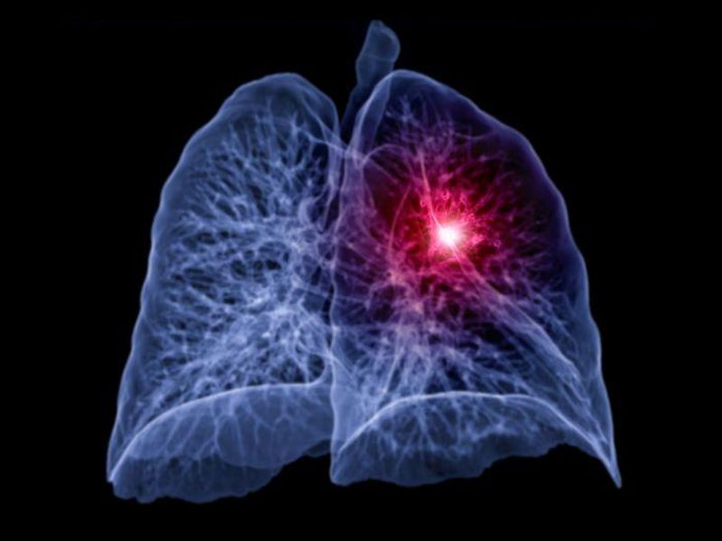 Surgical Treatment Provides Better Long-Term Survival for NSCLC